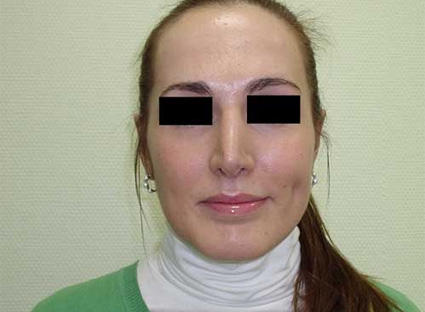Повторная ринопластика кончика носа стоимость