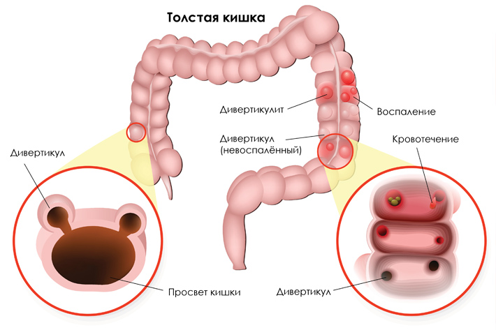 Дивертикулярная болезнь ободочной кишки. Простыми словами