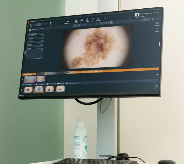 Ранний скрининг рака кожи (FotoFinder)