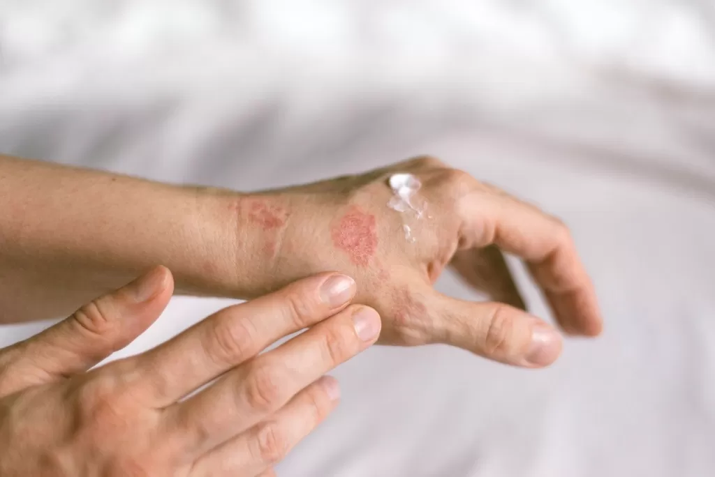 Крапивница