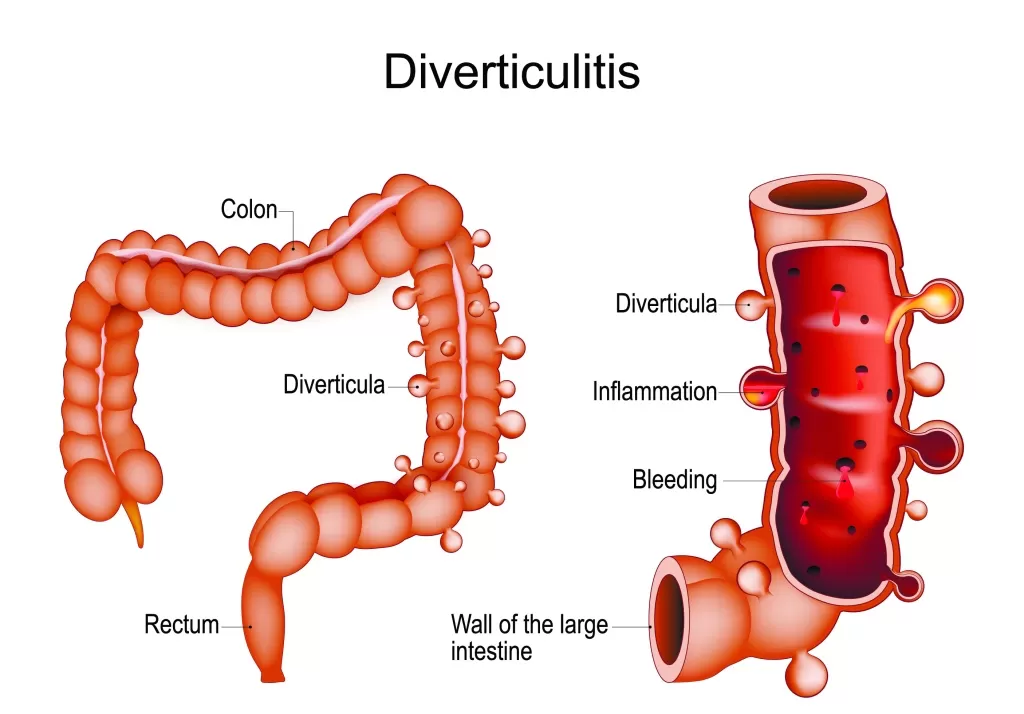 Дивертикулярная болезнь ободочной кишки. Простыми словами