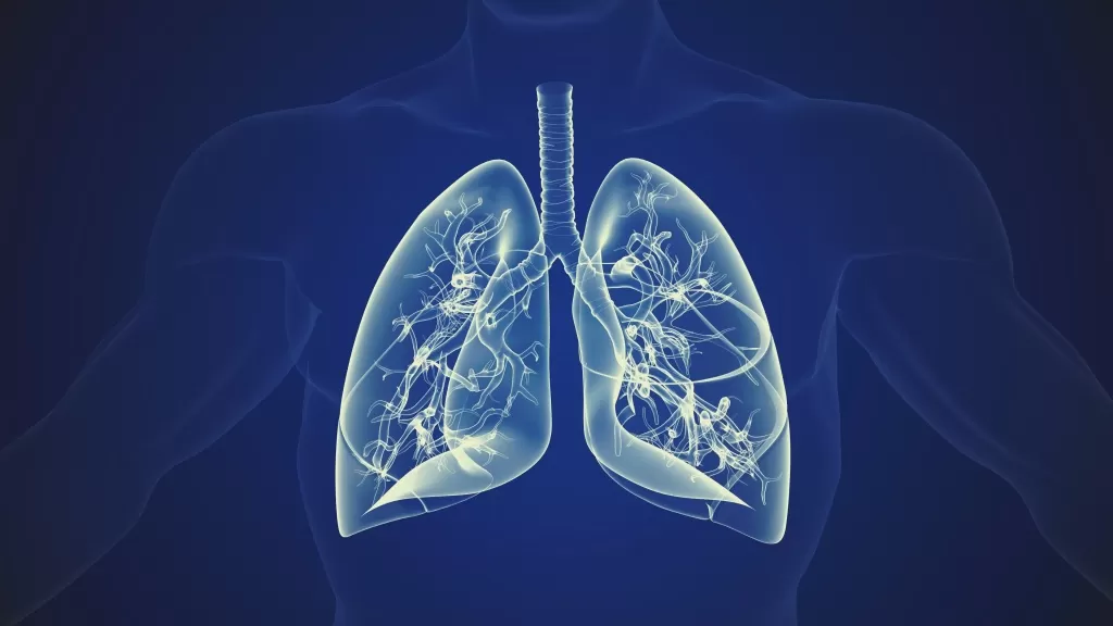 Пневмония (воспаление легких)