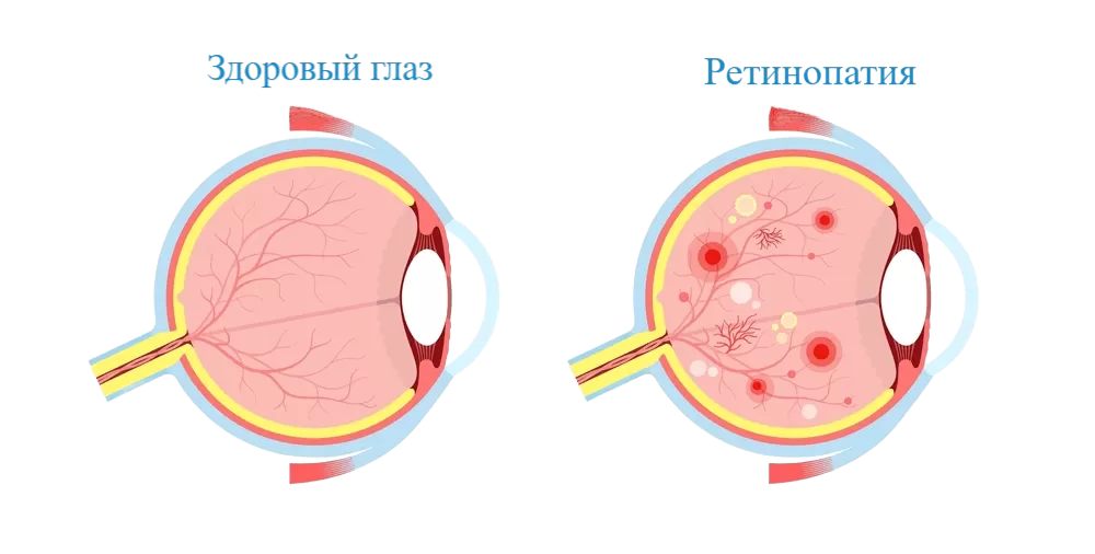 Ретинопатия.png