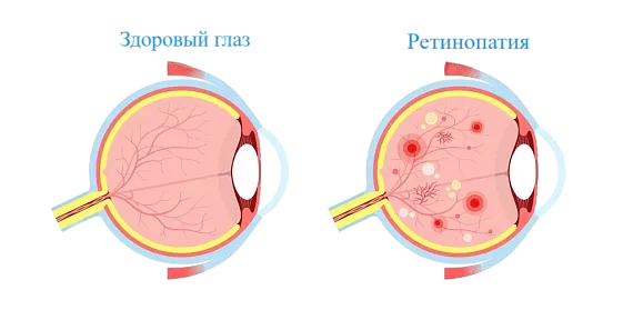 Диабетическая ретинопатия