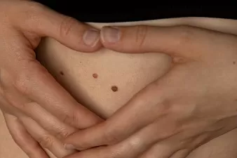 Стоит ли бояться сосудистой опухоли?