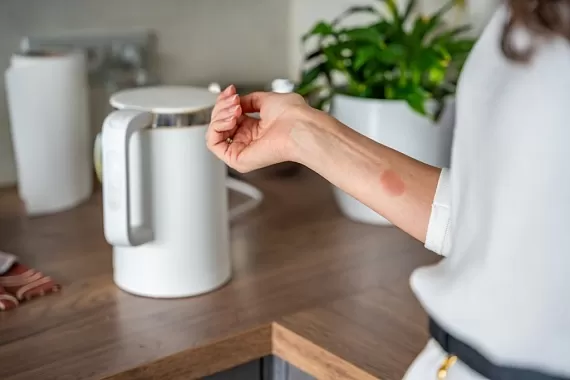 Сметаной — нельзя, медом — можно. Что делать при разных видах ожогов