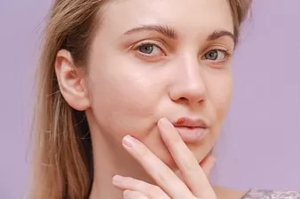 Чем лечить герпес на губах
