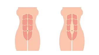 Как понять, что есть диастаз прямых мышц живота