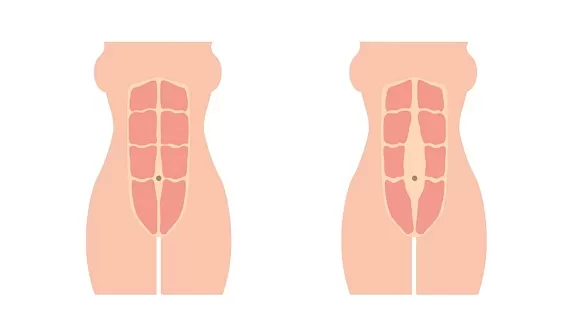 Как понять, что есть диастаз прямых мышц живота