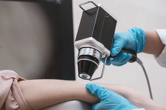 Меланома кожи