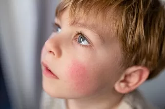 Детская аллергия: причины, виды