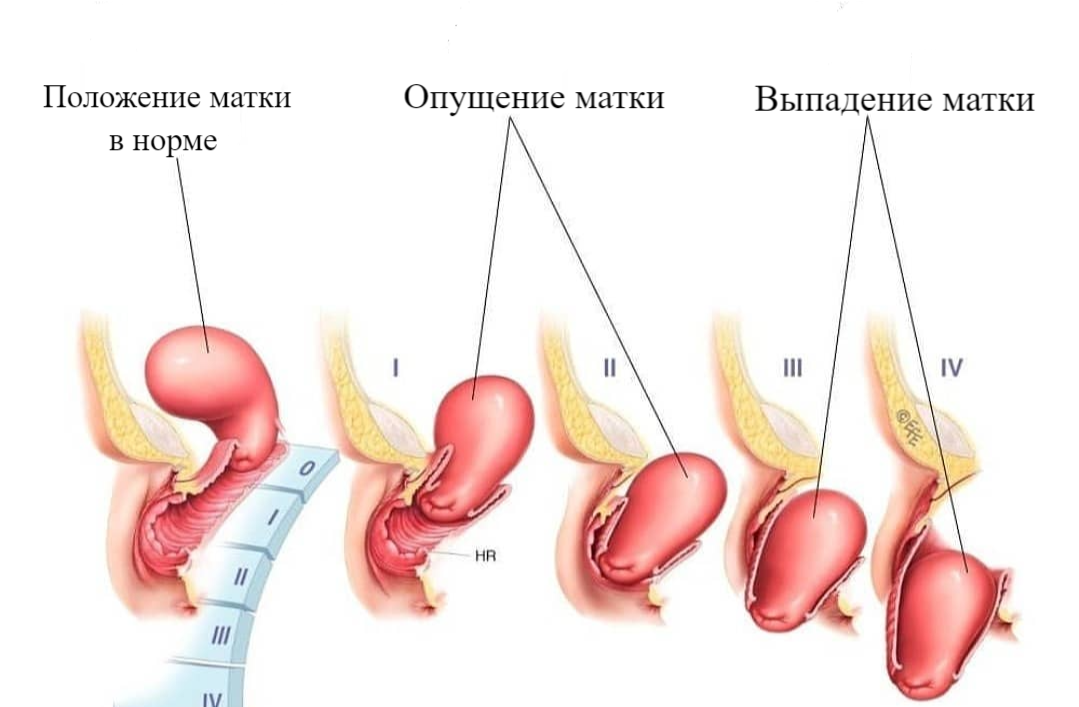 четыре степени опущения матки