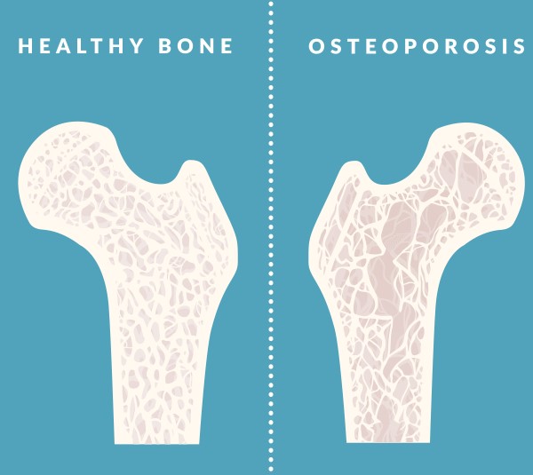 osteoporosis-bone-health.jpeg