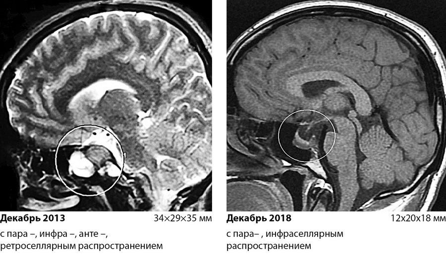 effektivnost-naznacheniya-vysokikh-doz-kabergolina-2.jpg