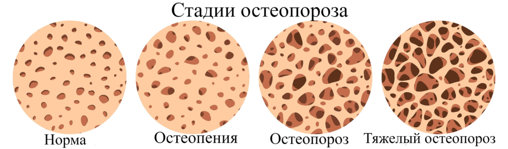 Симптомы ювенильного остеопороза