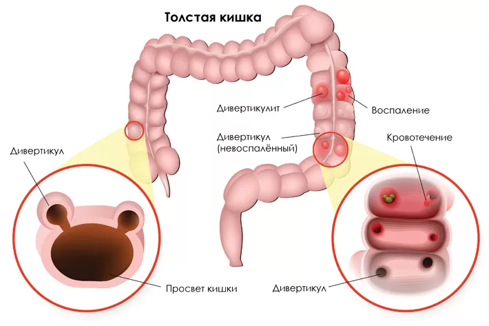 Дивертикулез ободочной кишки: лечение и диета у женщин после 50 лет